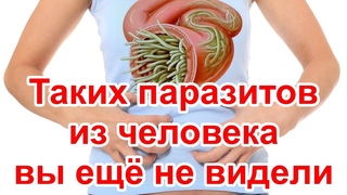 Таких паразитов из человека Я ещё не видел
