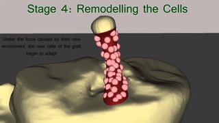 The Healing Process of the ACL Graft