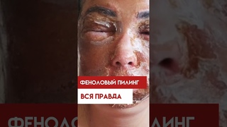 Феноловый пилинг. Вся правда о процедуре! #осложнения #косметология #пилинг #опасно